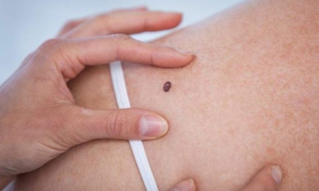 El melanoma se produce, en un 80%, por la exposición solar