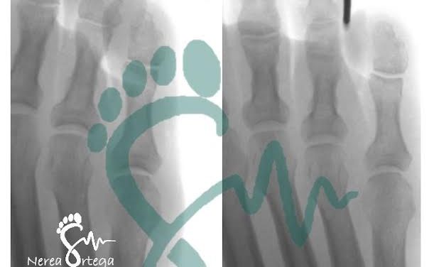 Qué son y cómo tratar los helomas