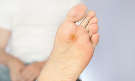 “Uno de cada cuatro pacientes diabéticos desarrollan una úlcera en el pie, y cuando esa úlcera no va bien, en el 70% de los casos acaba en amputación”